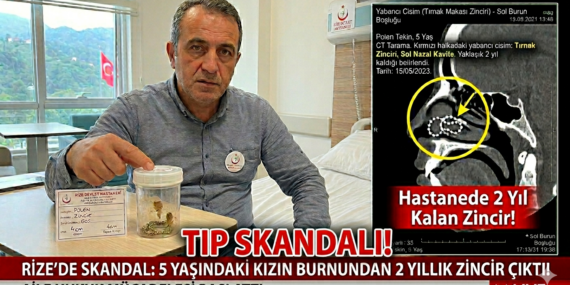 Rize’de Sağlık Skandalı! 5 Yaşındaki Polen’in Burnundan 2 Yıllık Zincir Çıktı